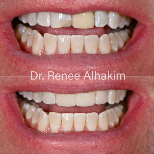 Perfectly aligned teeth