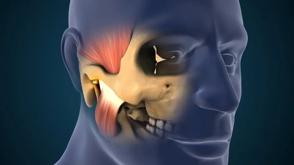 Medical Illustration of Temporomandibular Joint Disorder