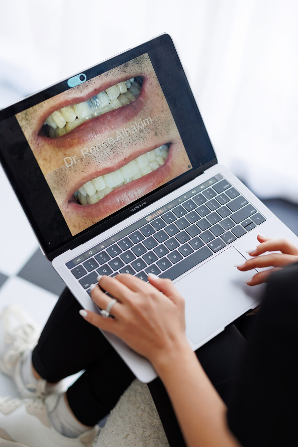 Before-and-after smile makeover case by Dr. Renee Alhakim